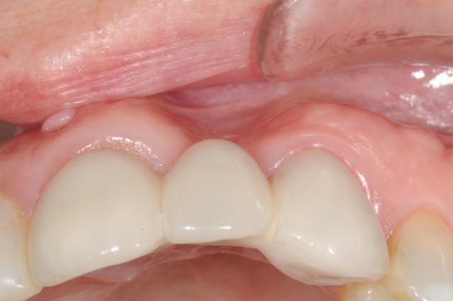 Bone loss after extraction front tooth