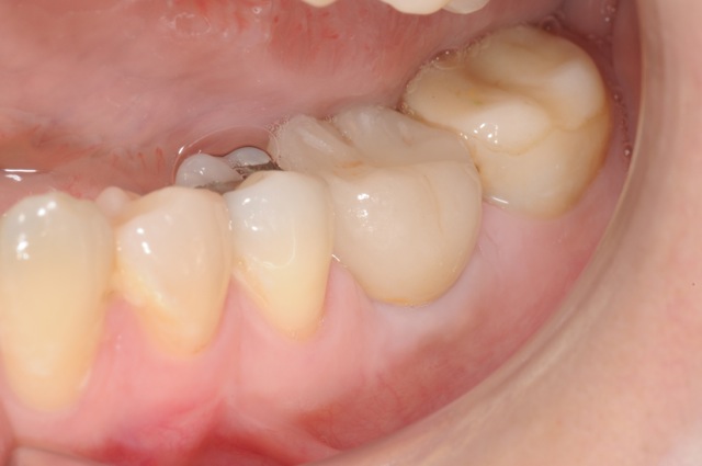 Implant lower molar with crown
