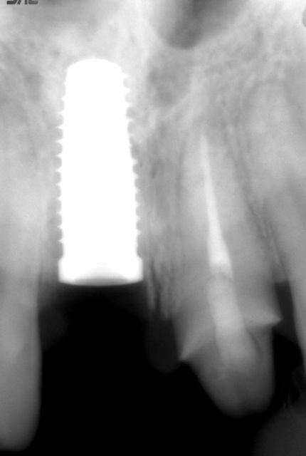 Implant in the front incisor