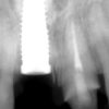 Implant in the front incisor