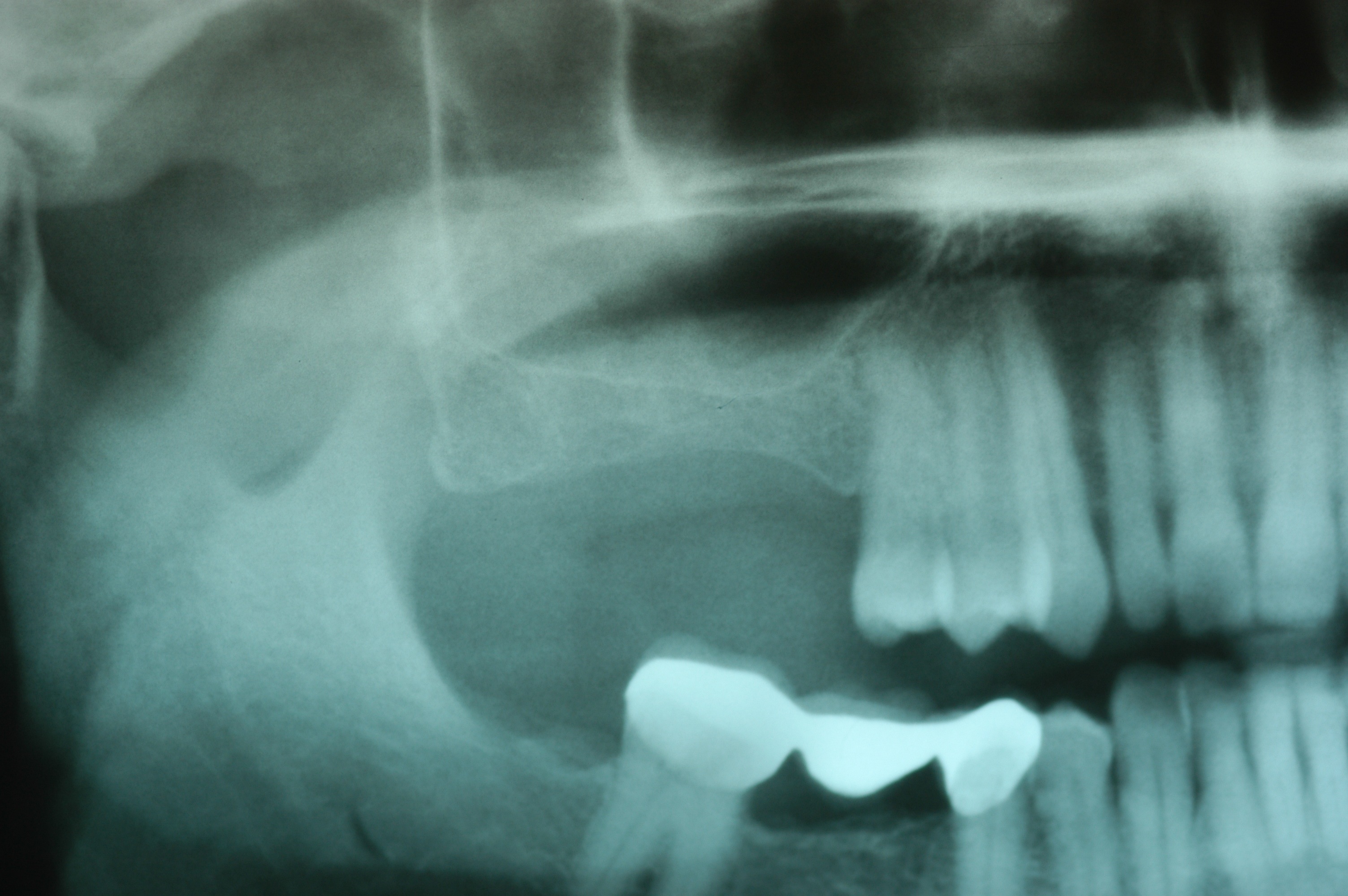 Missing upper molars with inadequate height of bone due to sinus