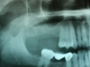 Missing upper molars with inadequate height of bone due to sinus