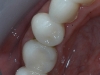 After grafting, three implants placed with single crowns.