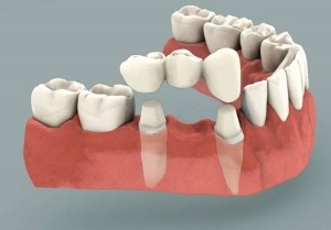 Dental bridge