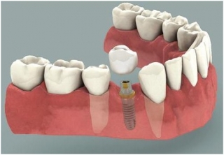 dental implant
