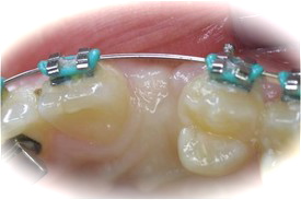 Orthodontic treatment for impacted canines