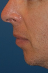 Chin implant- before