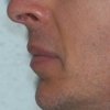 Chin augmentation with implant