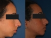 1-before-and-after-lower-jaw-surgery