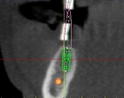 CT scan with implant placement