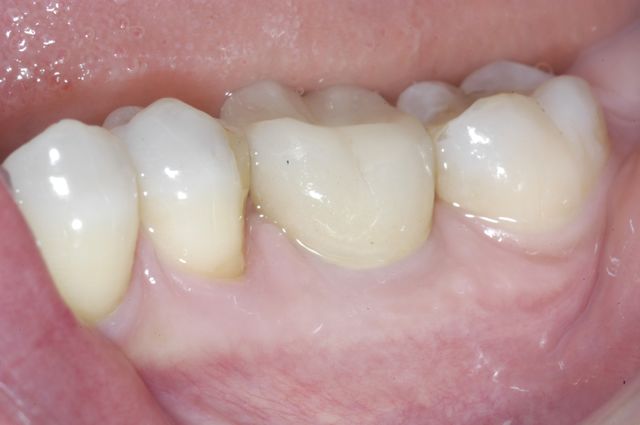 Patient C- Single lower molar