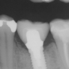 Patient A- Lower single molar