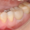 Patient B- Lower two molars
