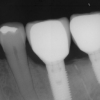 Patient B- Lower two molars