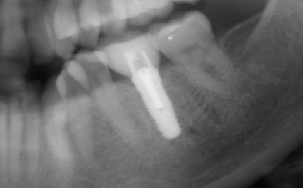 Patient C- Single lower molar