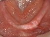 Complete missing lower teeth