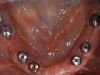 Patient wanted a fully fixed bridge. Eight implants were placed