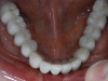Final bridge is cemented and fully supported by implants