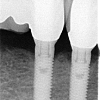 Implants- 11 years