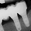 Left side implants- 11 years