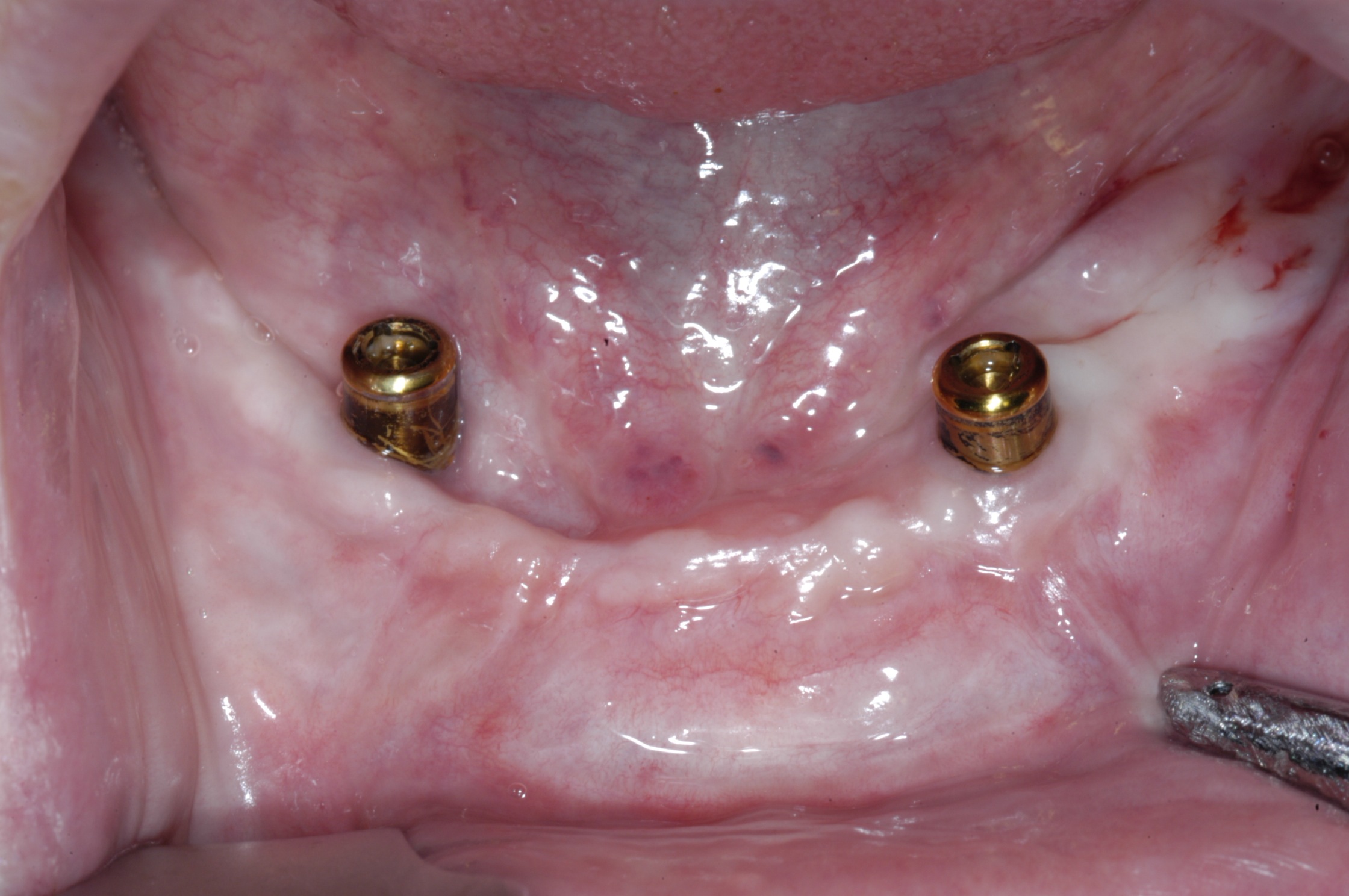 Two implants for overdenture support