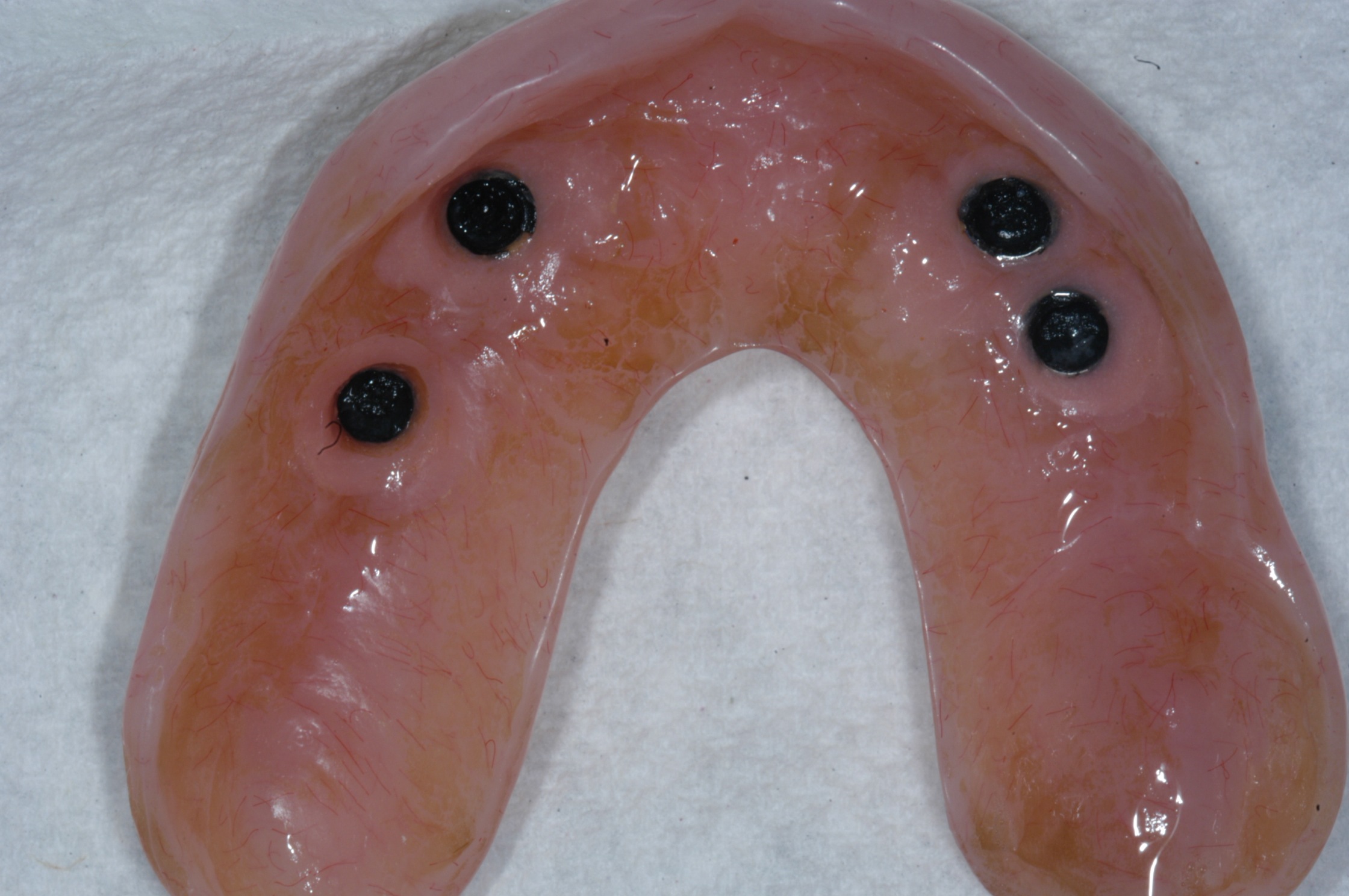 Overdenture with attachments