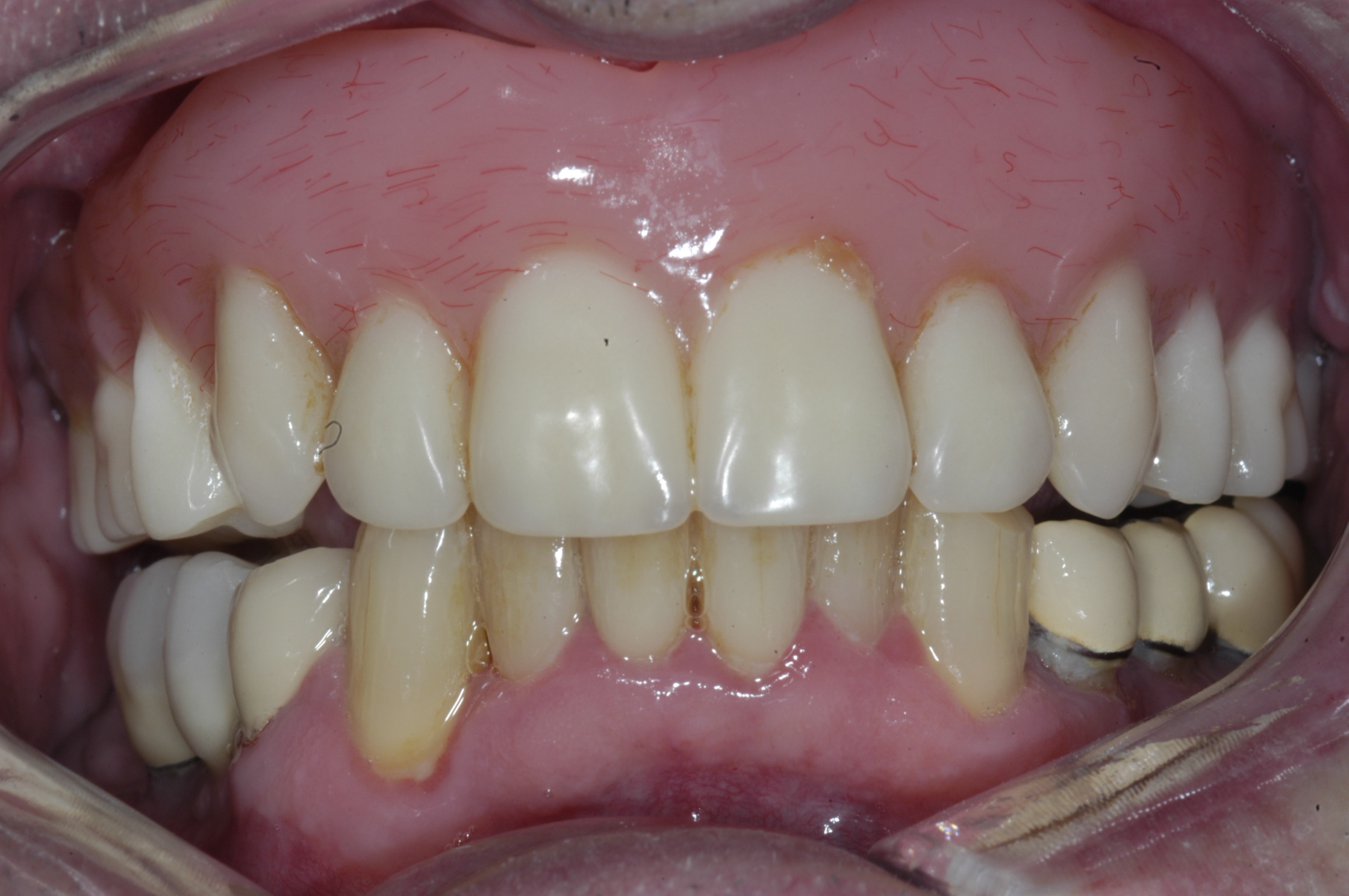 Overdenture is supported by four implants