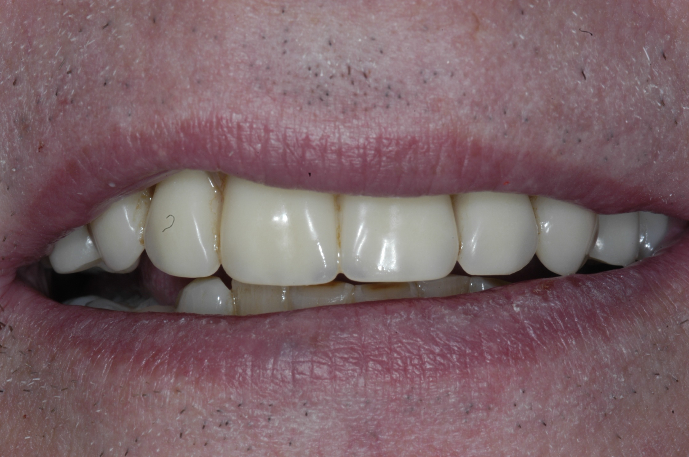 Natural smile and great denture stability