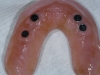 Overdenture with attachments
