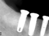 Three implants to replace missing lower teeth
