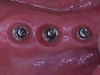 Implants healed and positioned in ideal location