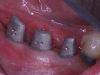 Custom extensions placed on implants