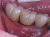 Final crowns suppported by the implants