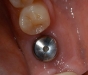 Missing lower molar replaced with single implant