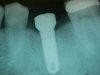 Implant in ideal location