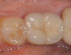 Final crown supported by implant