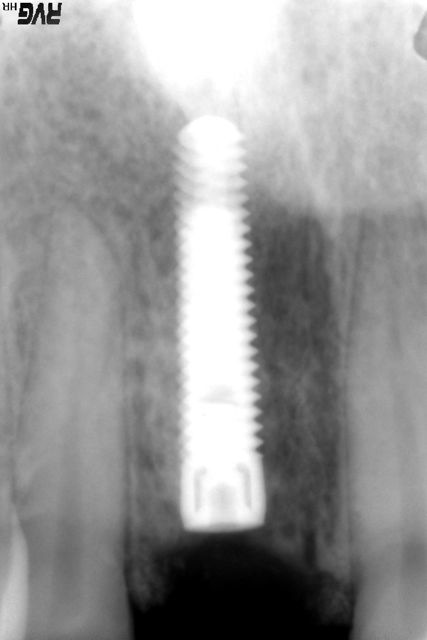 Placement of implant in ideal position