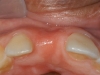 Missing incisor with thin bone
