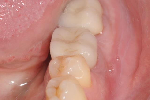 Dental implant crown