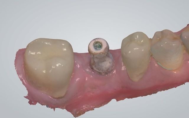 Intra-oral scan of dental implant using scan body