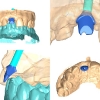 CAD crown