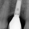 Final X-ray