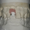 Final abutment