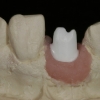 Final abutment