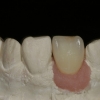 Final crown