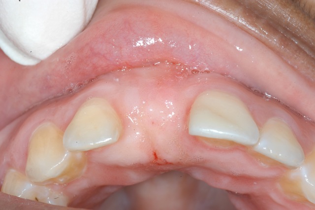 Extracted upper incisor site