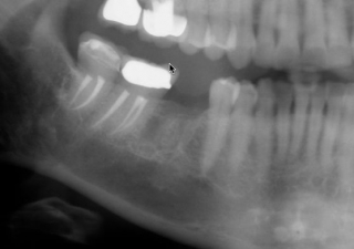 Missing tooth #30 lower molar