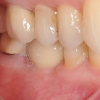 Crown and bite- molar with dental implant