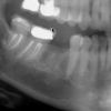 Missing tooth #30 lower molar