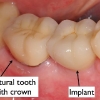 Final crown on dental implant- Dr. Kazemi
